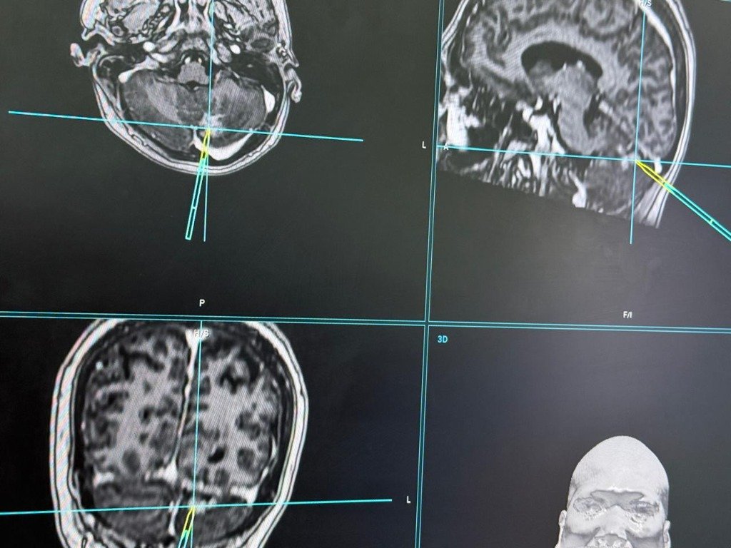 Neuronavigation System